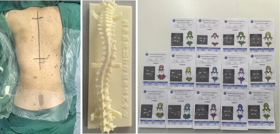 3D打印及手术规划报告