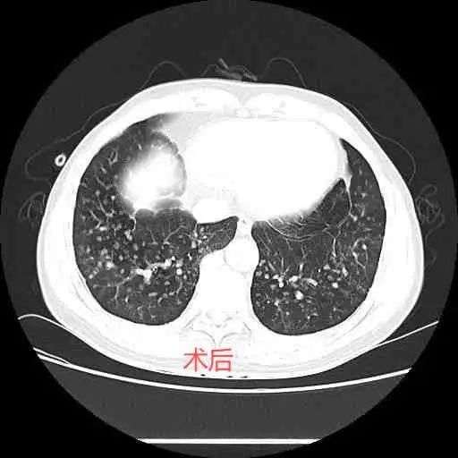 术后