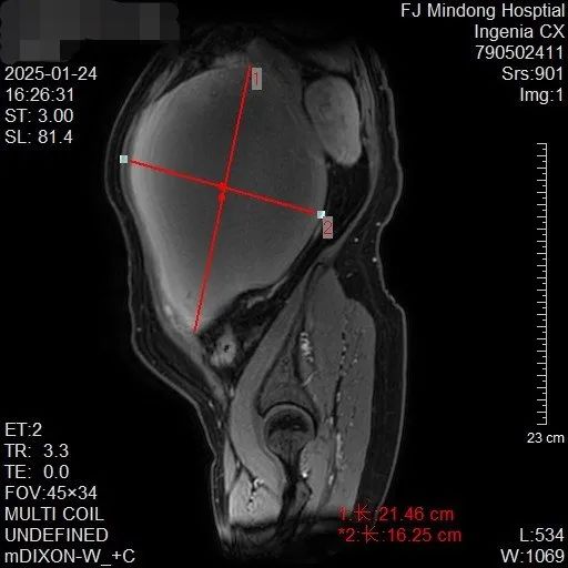 盆腔MRI