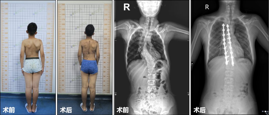 术前术后对比